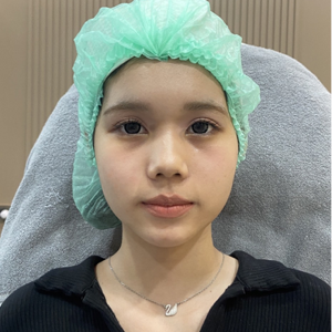 ใต้ตา BEFORE - TYP