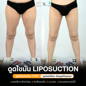 ดูดไขมัน