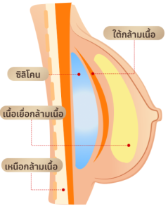 เสริมหน้าอกด้วยเทคนิค Dual Plane