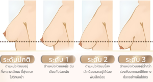 ระดับความหย่อนคล้อยของหน้าอก