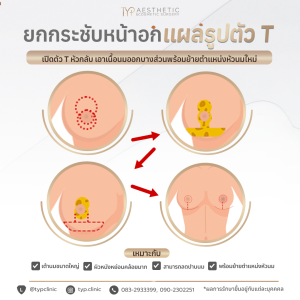 เทคนิคผ่าตัดเต้านมตัว T - TYP