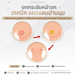 เทคนิคลดขนาดเต้านม ตัว o - TYP