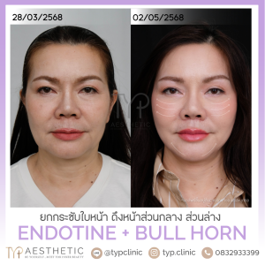 Endotine