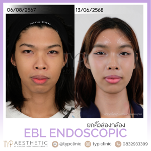 EBL