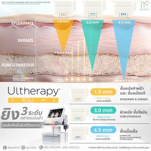 Ultherapy prime - TYP
